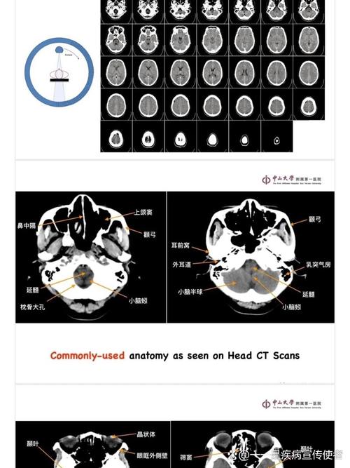 脑梗复查要做ct还是脑彩超