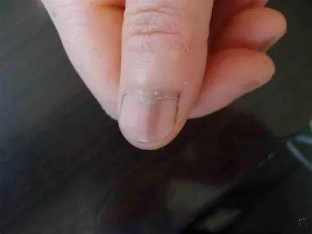 指甲黑色竖线 中医穴位