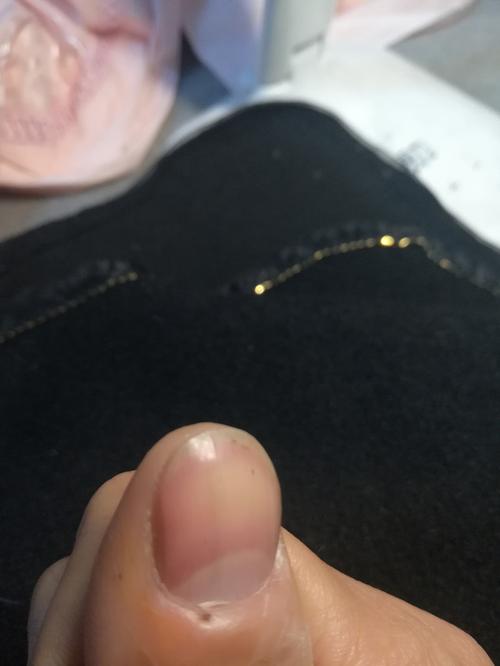 指甲黑色竖线 中医穴位