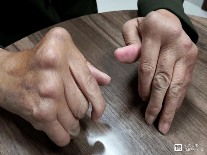 类风湿性关节炎类风湿性关节炎