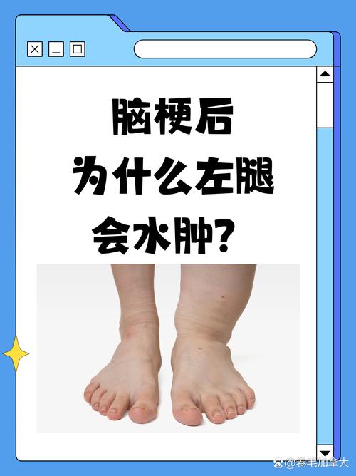 脑梗后手脚浮肿是怎么一回事
