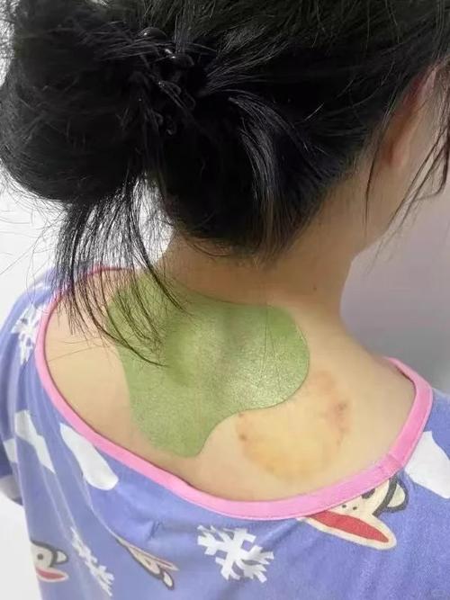 中药穴位敷贴 皮肤发青