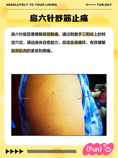 肩周炎针灸穴位视频在线