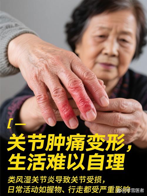 全国治疗类风湿最好的医院排名