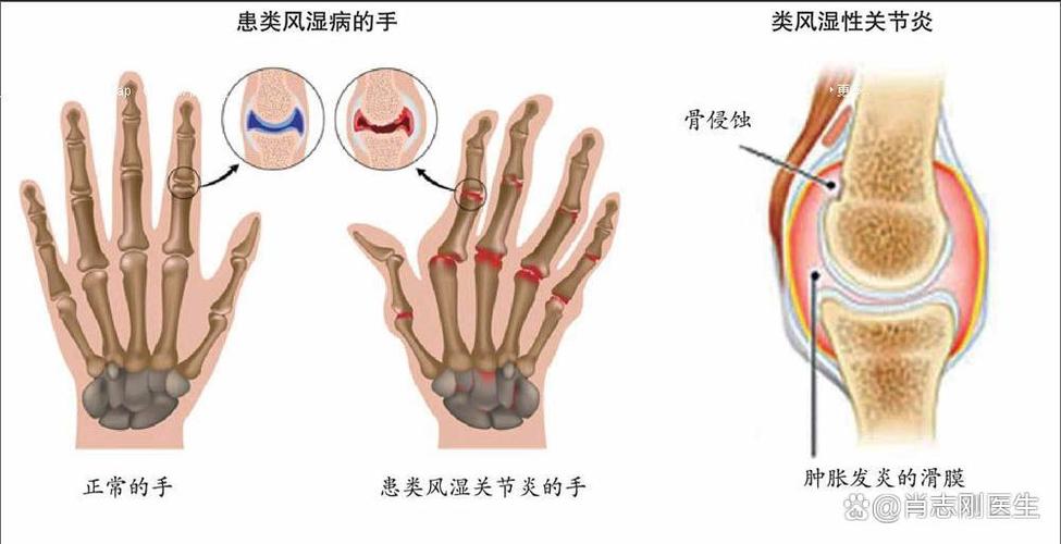 抗o多少是风湿能确定为风湿