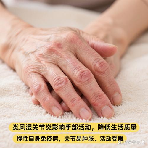 全国治疗类风湿医院前10名