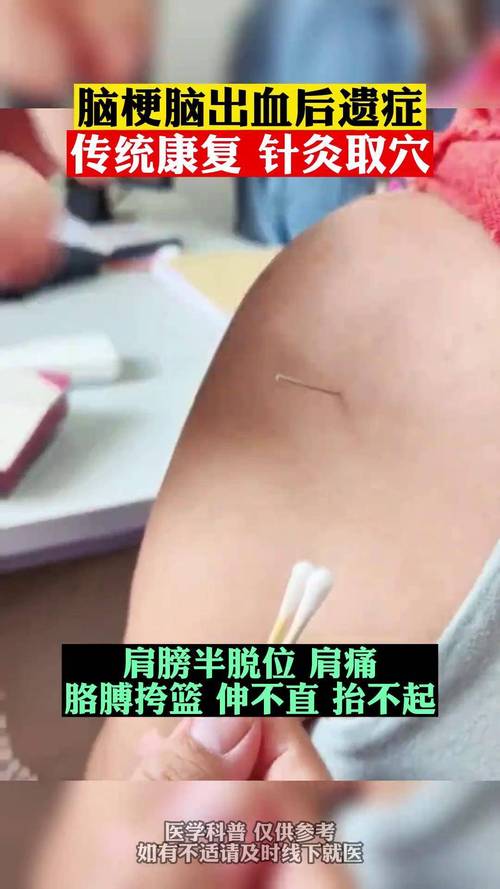 昏迷病人 针灸 穴位