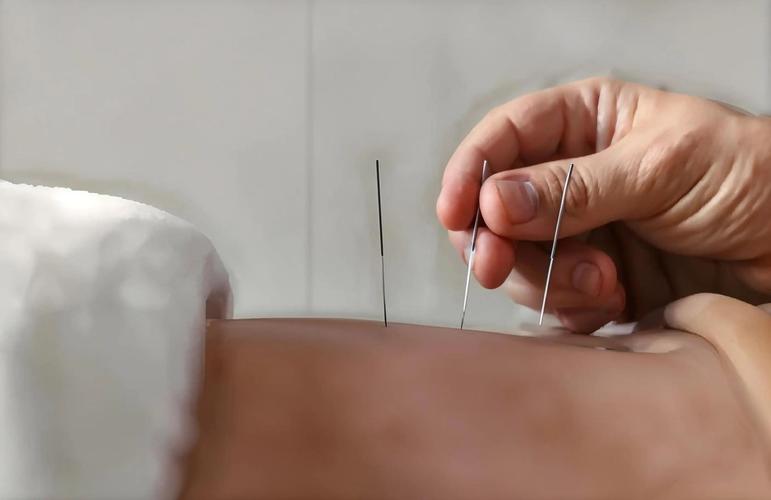 昏迷病人 针灸 穴位