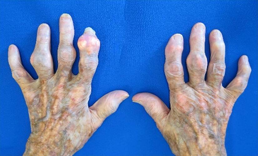 风湿性关节炎类风湿性关节炎