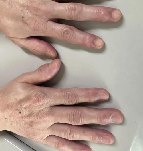 风湿关节炎 类风湿性关节炎