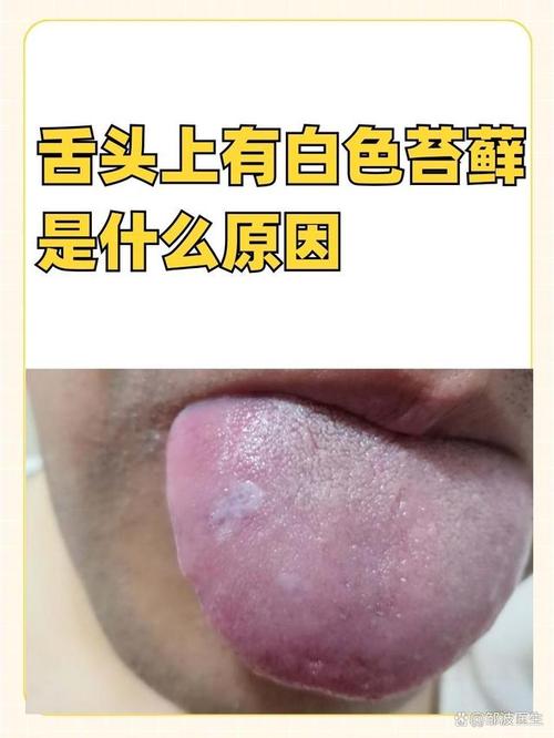 脑梗不能吞咽 舌苔发白