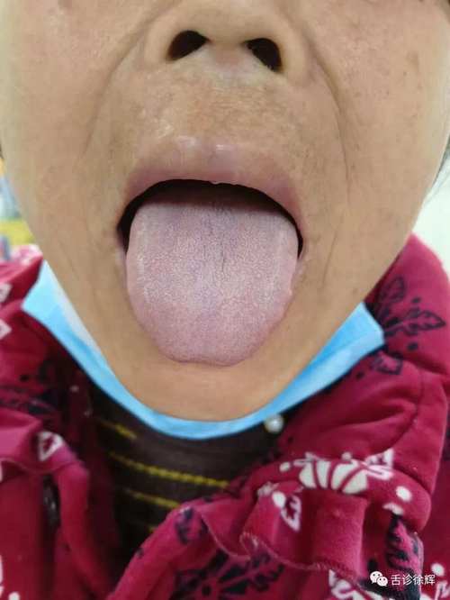 脑梗不能吞咽 舌苔发白
