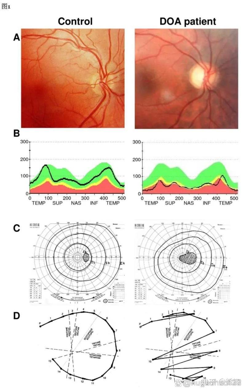 脑梗 恢复 眼神经萎缩