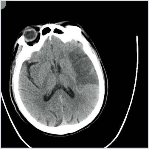 ct未见明显异常 脑梗