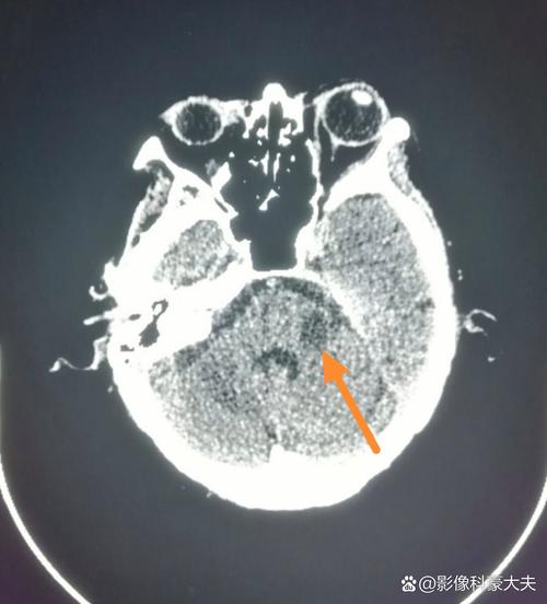 ct未见明显异常 脑梗