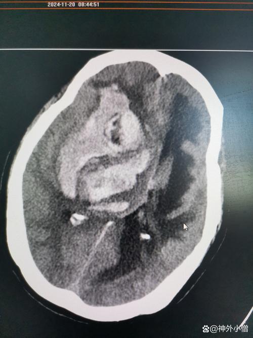 脑梗 瞳孔光线 没反应