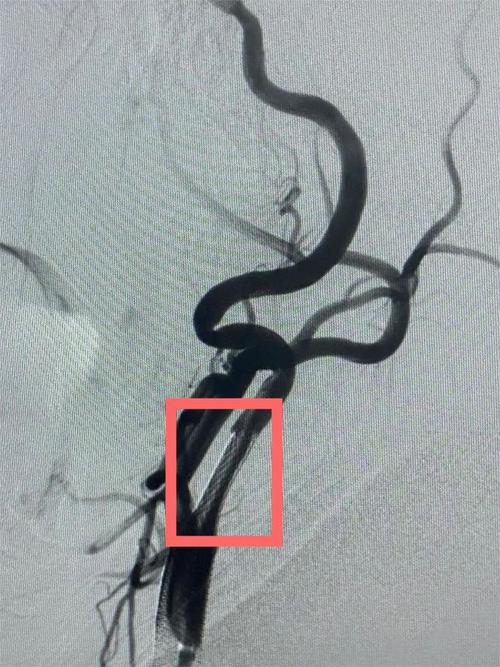脑梗 颈动脉支架 案例