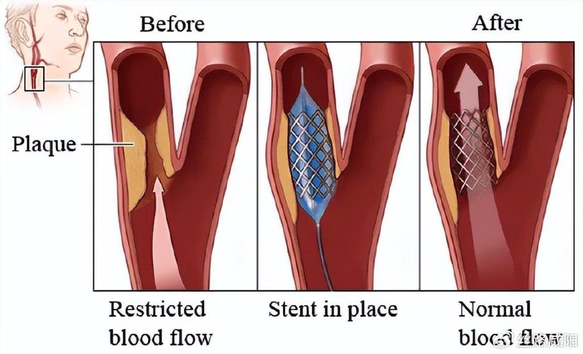 脑梗 颈动脉支架 案例
