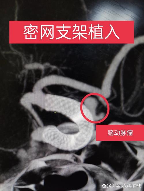 脑梗 颈动脉支架 案例