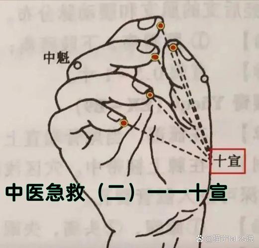 中医针灸穴位十宣穴位置