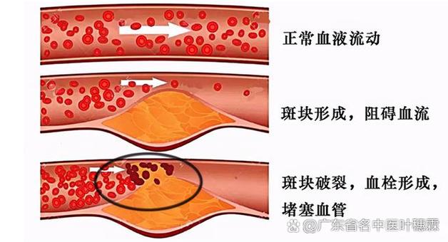 有几种技术治脑梗和心梗