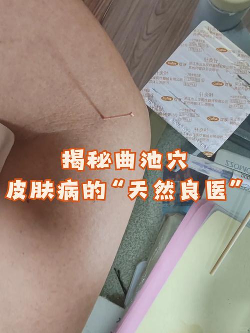 曲池穴位如何做穴位注射