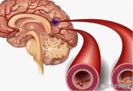 脑梗脑供血不足为什么腿
