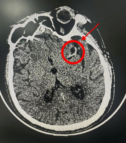 做脑ct正常会有脑梗吗
