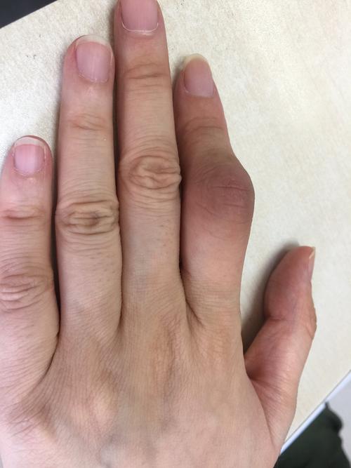 手指 关节 肿大 风湿