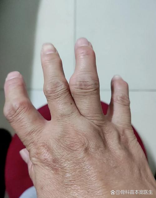 手指 关节 肿大 风湿