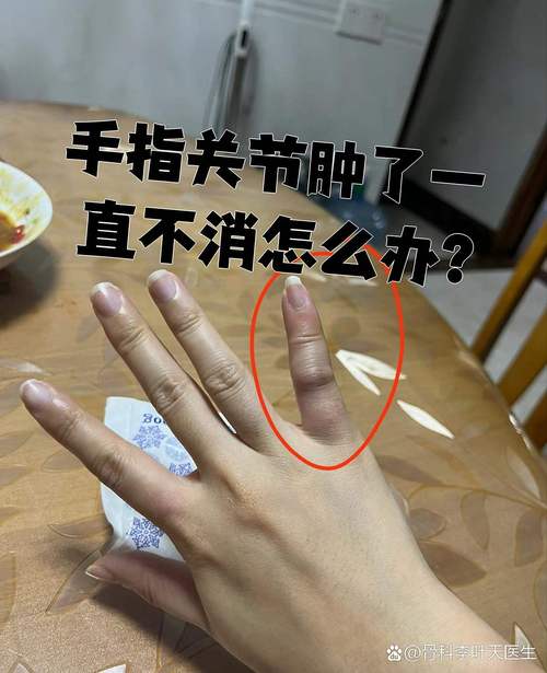 手指 关节 肿大 风湿