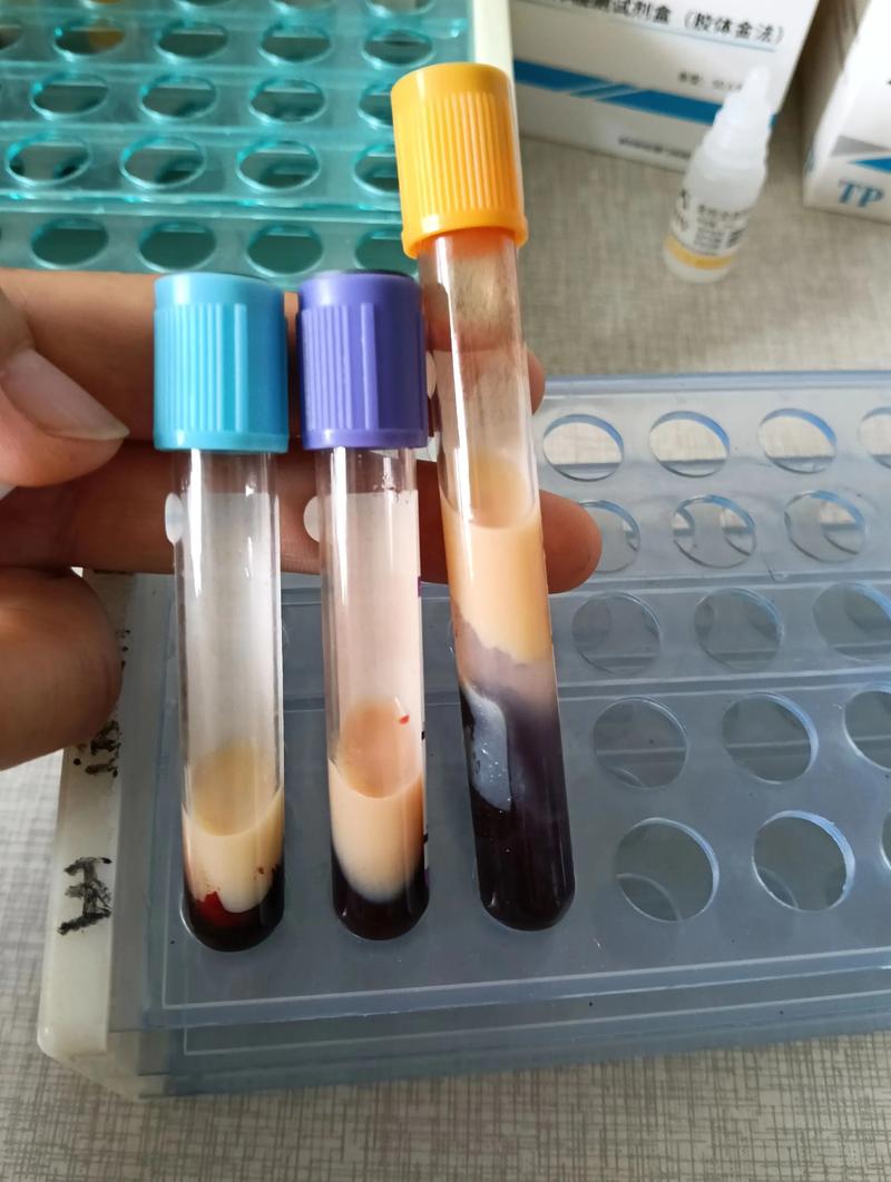 风湿 抽血 化验 吃饭