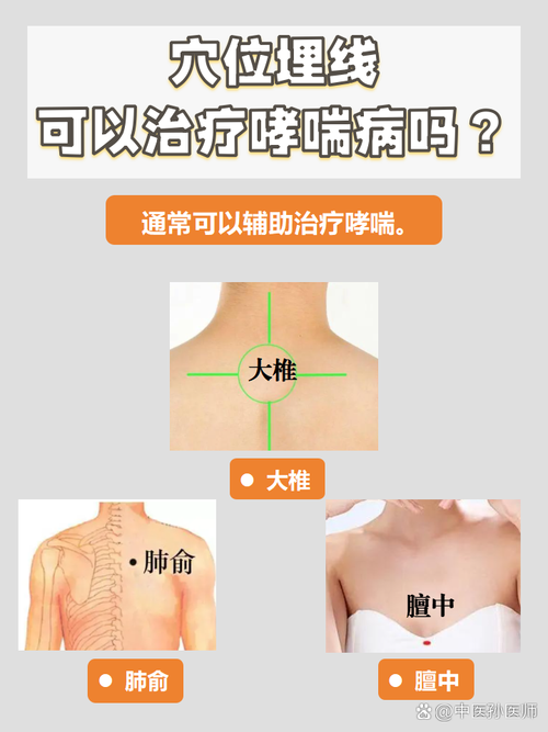 穴位埋线治疗过敏性哮喘