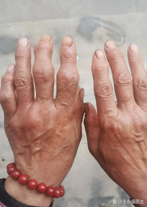 风湿就是风湿性关节炎吗