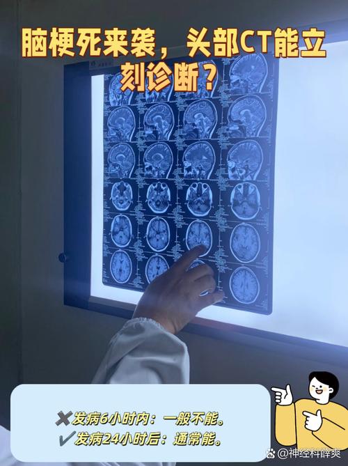 只做脑ct能查出脑梗吗
