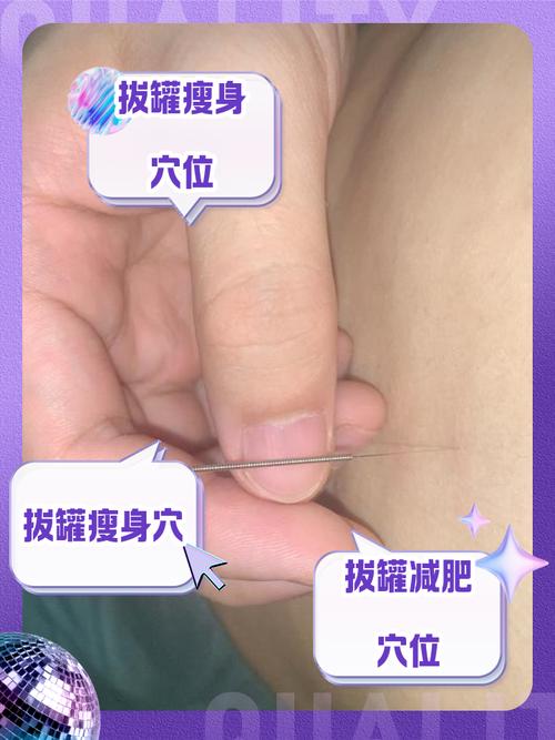 拔罐减肥瘦身穴位及方法