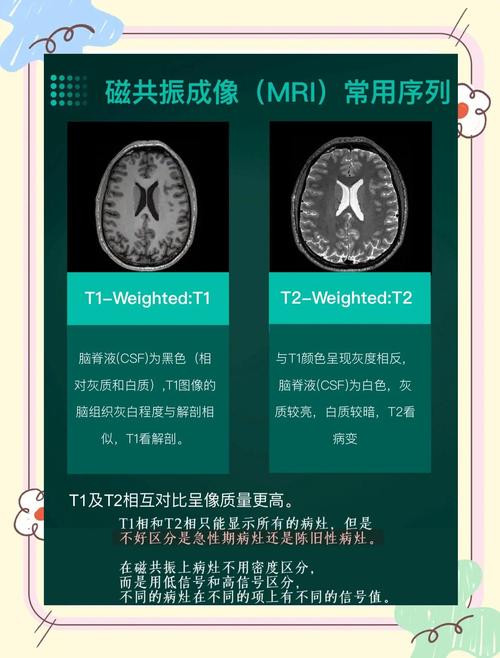 查否脑梗腔梗什么比较准