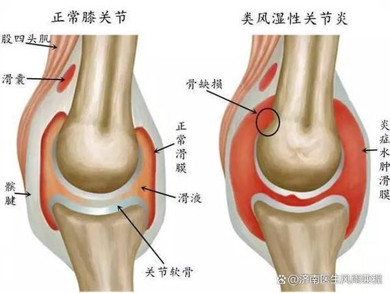 类风湿关节炎抗风湿药物