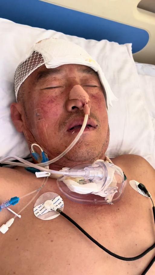 80岁脑梗又心梗后昏迷