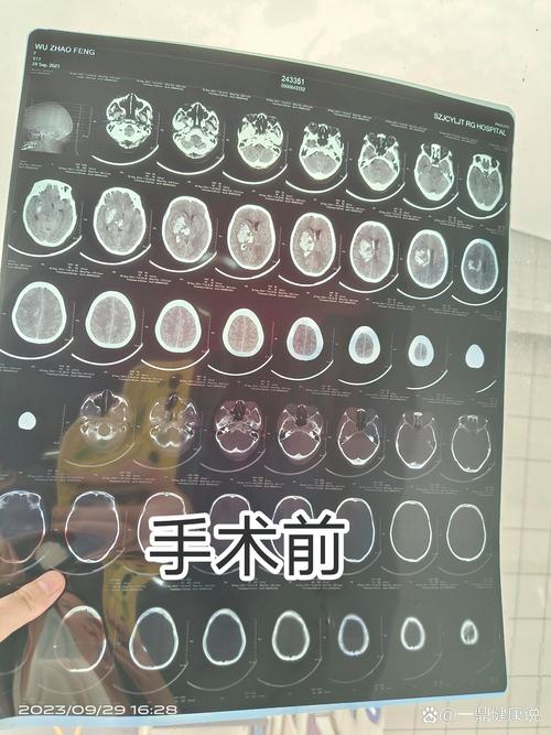 脑血流图能检查出脑梗么