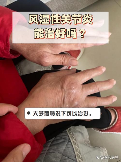 风湿病早期的症状风湿病
