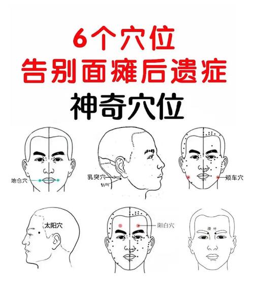 面瘫需要艾灸哪些穴位