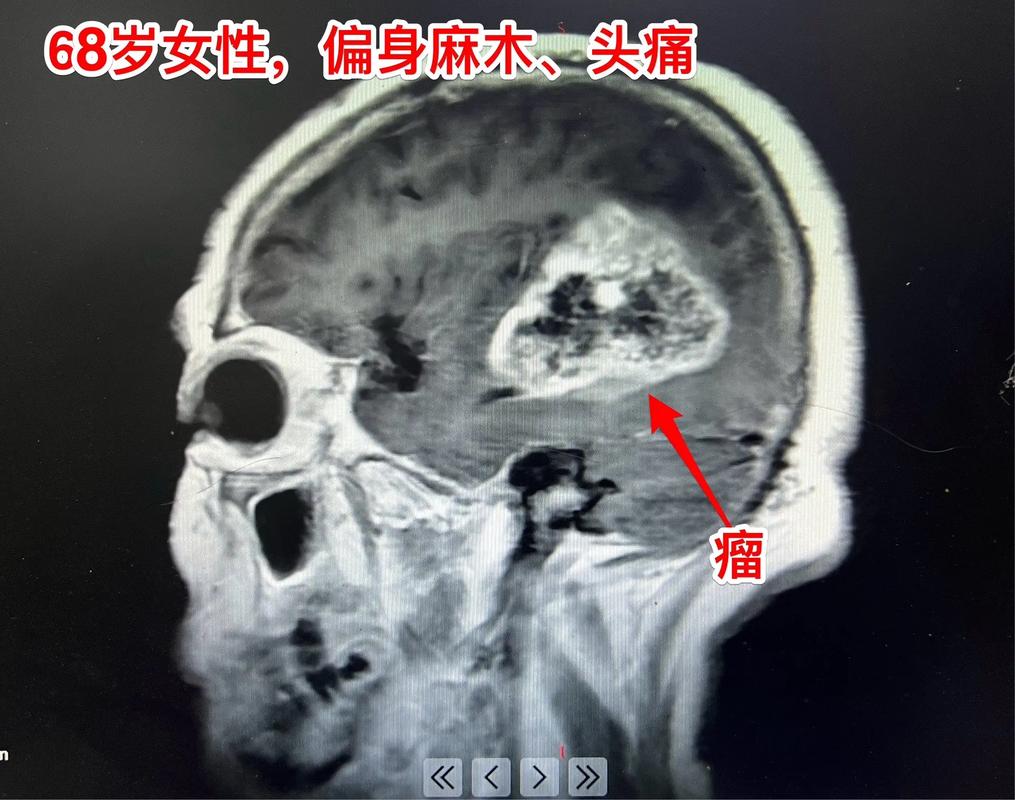 65岁头疼脑梗脑胶质瘤