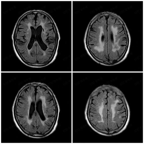 脑白质脱随乔贫血性脑梗