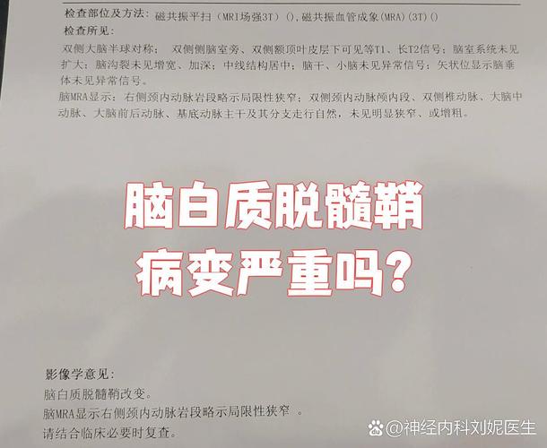 脑白质脱随乔贫血性脑梗