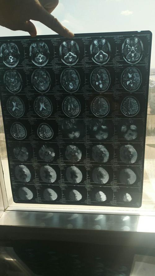 脑梗溶栓后梗面积稍扩大