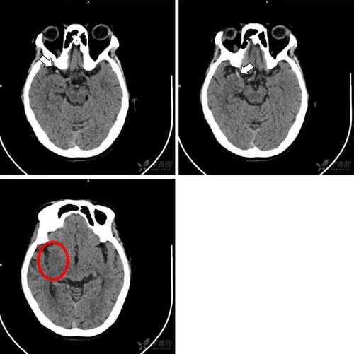 脑ct检查脑梗的准确率