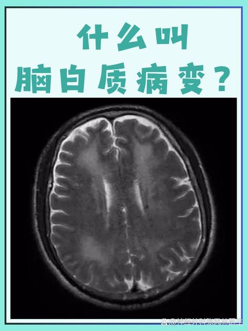 脑白质病变是脑梗前兆吗
