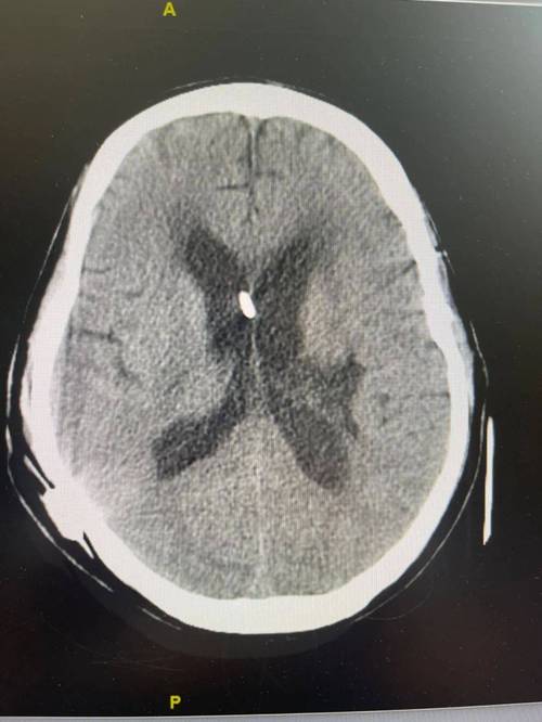 双侧脑旁多发缺血脑梗灶