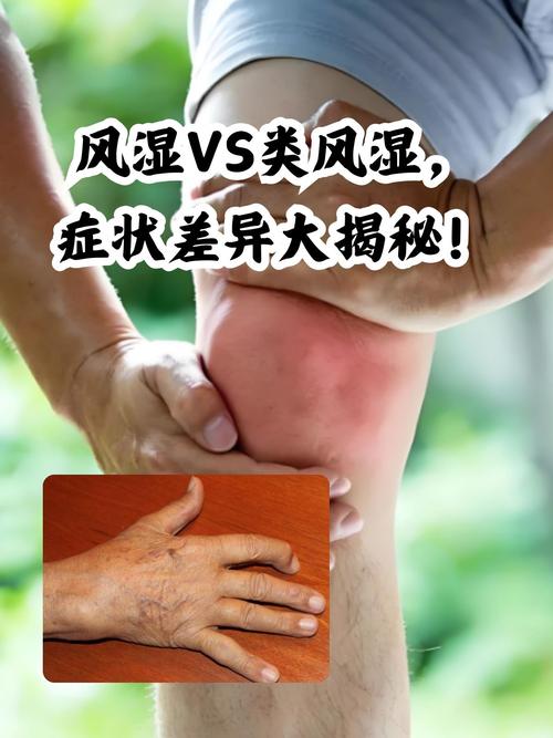风湿和类风湿有看好的吗